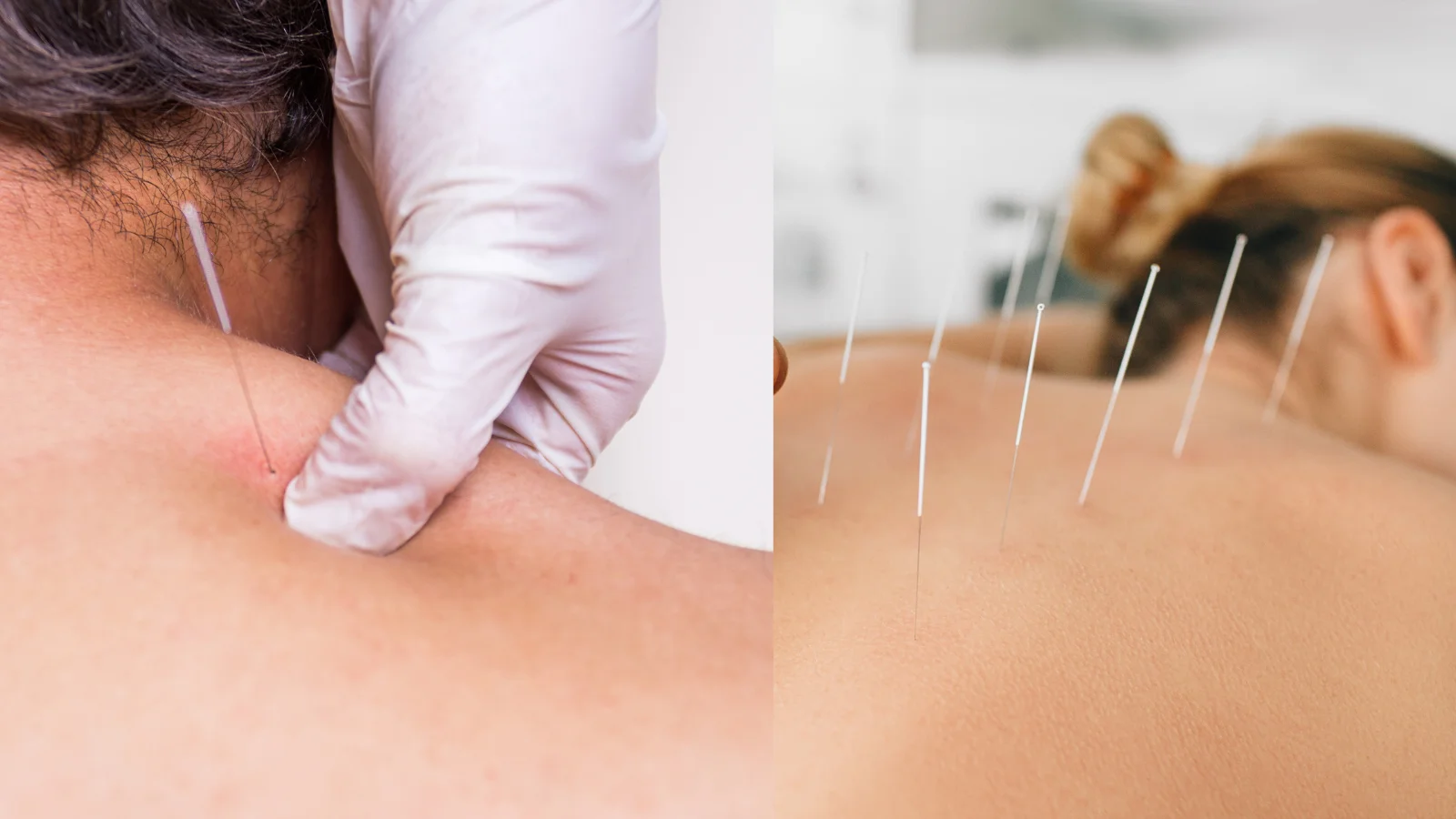 Is Dry Needling and Acupuncture the Same Thing?